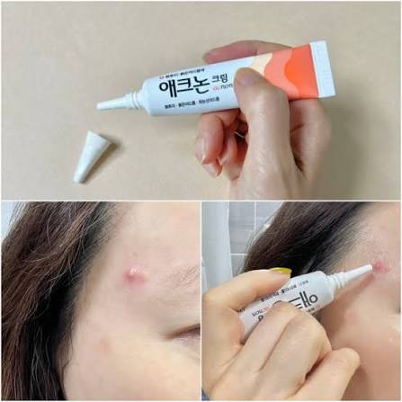 [동아] 애크논 크림 (여드름 & 뾰루지 크림)